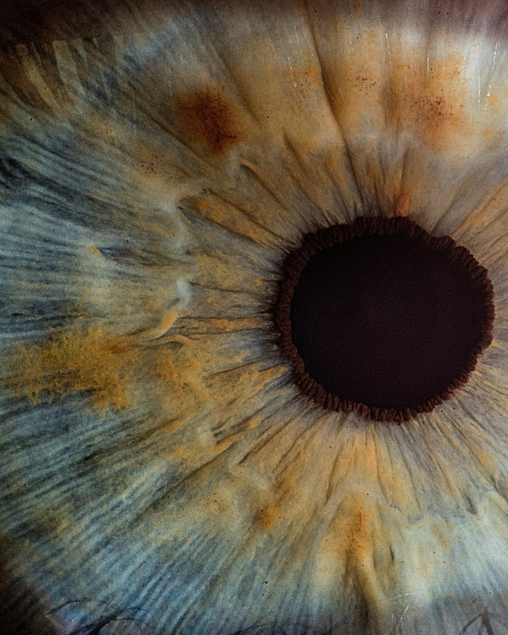 Glaucoma - Clin Olhar