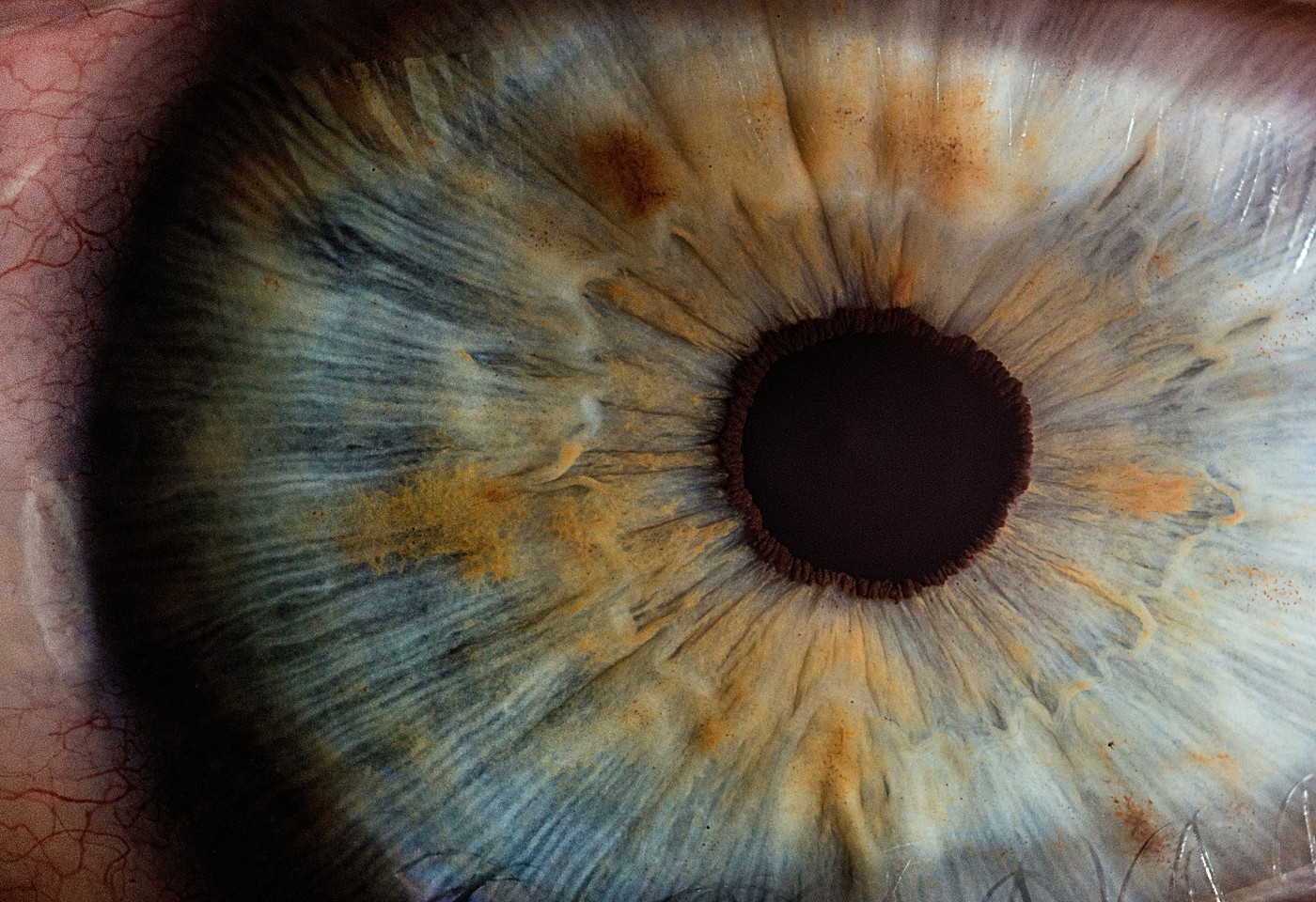Glaucoma - Clin Olhar